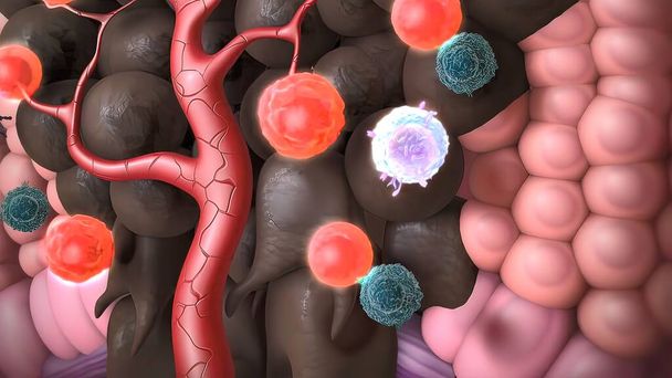 3d ilustración médica del cáncer de piel: carcinoma de células escamosas, cáncer de células basales - Foto, Imagen