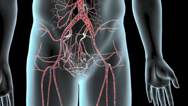 3D lékařská ilustrace pulzního abdominálního aortálního aneurysma - Fotografie, Obrázek