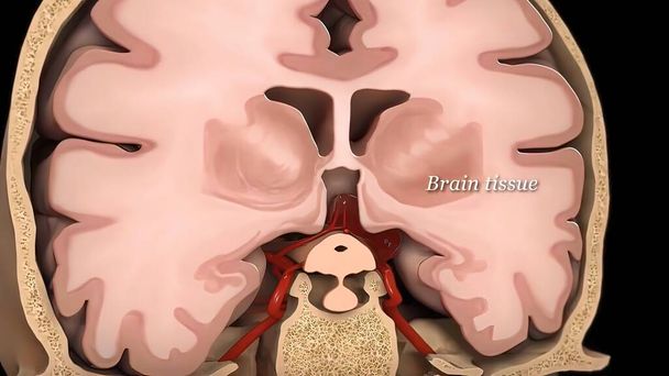 Ilustración médica 3D de lesión cerebral - Foto, imagen