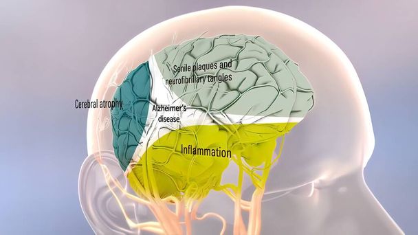 Amyloid-Vorläuferproteinverarbeitung und Alzheimer 3D-Illustration - Foto, Bild