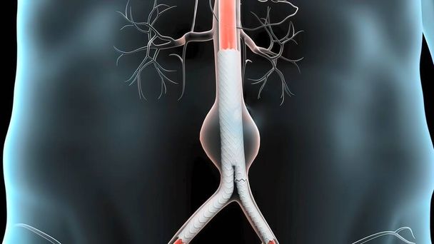 3D medical illustration of pulsatile Abdominal Aortic Aneurysm - Photo, Image