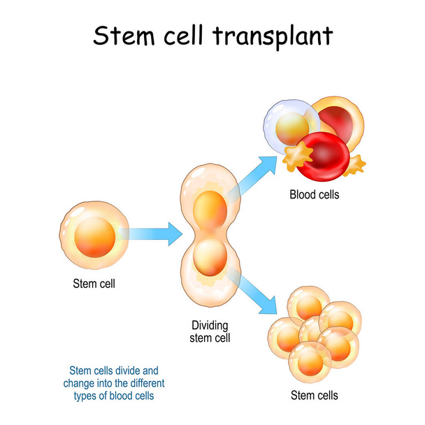 Trapianto di cellule staminali. Le cellule staminali si dividono e cambiano nei diversi tipi di cellule del sangue. Illustrazione vettoriale - Vettoriali, immagini