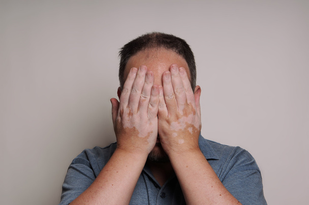 Mann mit Vitiligo versteckt Gesicht - Foto, Bild