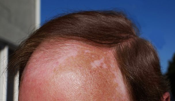 Quemaduras de sol y vitiligo - Foto, Imagen