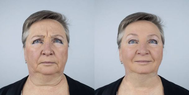 Una anciana en la recepción de un cirujano plástico facial. Consulta sobre la eliminación de las arrugas de edad en la cara. El médico muestra qué procedimientos hará. Mímicas arrugas. Contorno plástico - Foto, Imagen