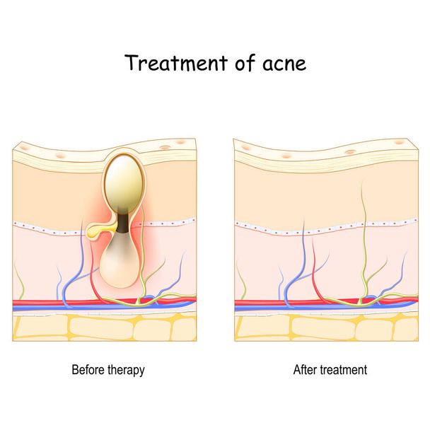 Akne-Behandlung. Vor und nach der Therapie. Querschnitt durch die Haut. Vektorplakat - Vektor, Bild