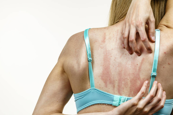 Young woman suffering from itching on her skin and scratching itchy back. Allergic reaction to food, dermatitis. Health care. - Photo, image