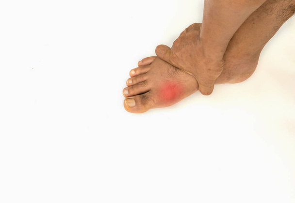 Jalkatauti Reumatismi ja kihti. Punaisen jalan turvotus. Jalkakipu
  - Valokuva, kuva