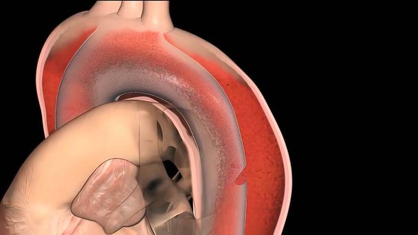低形成左心症候群は、心臓の左側がひどく開発されていないまれな先天性心不全であります.これは、左室室に影響を与える可能性があります,大動脈,大動脈弁,または僧帽弁.3Dレンダリング - 写真・画像