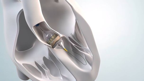 Expansión del implante transcatéter de válvula aórtica.3D Medical 3D Render . - Foto, imagen