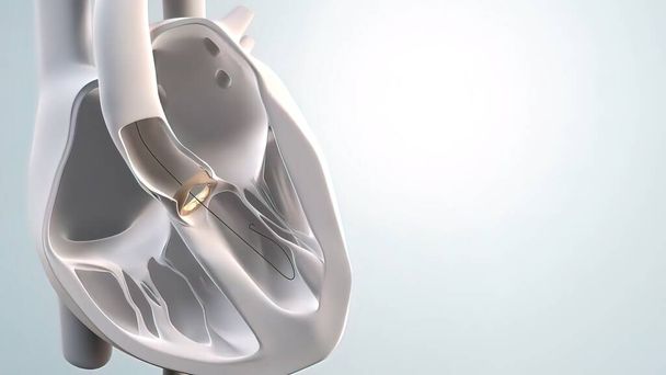 Expansión del implante transcatéter de válvula aórtica.3D Medical 3D Render . - Foto, Imagen