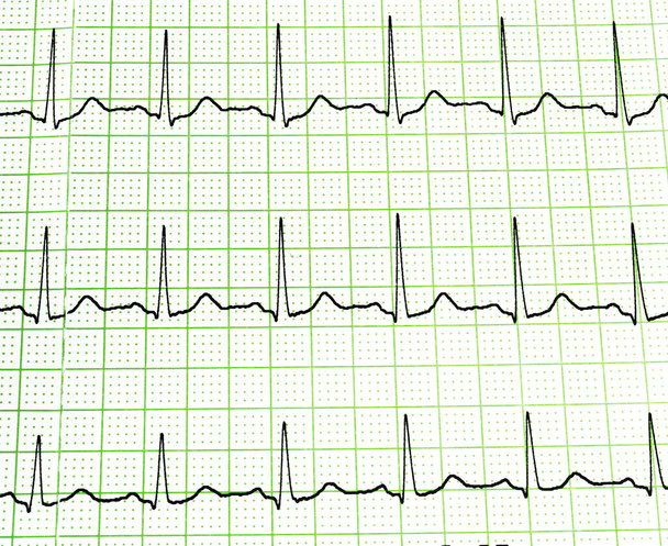 Badanie elektrokardiograficzne wykazujące aktywność elektryczną serca. - Zdjęcie, obraz