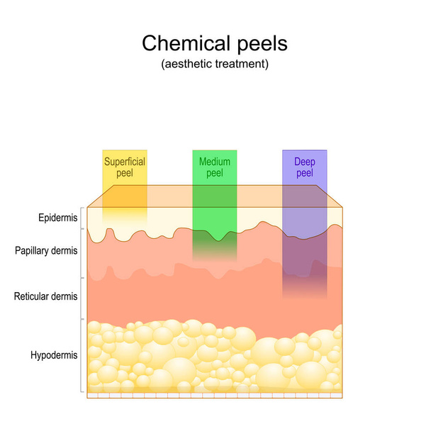 Beauty aesthetic treatment. Chemical peels. Deep, medium, Superficial peel. Cross section of layers of human skin. Vector illustration - Vector, Image