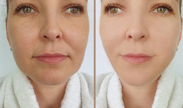 arrugas faciales de la mujer antes y después del tratamiento  - Foto, Imagen