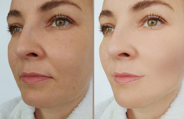 woman face wrinkles before and after treatment  - Photo, Image