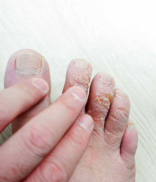 zblízka kožní onemocnění nohou, tvorba mozolů na prstech, mozoly na horní části prstů, - Fotografie, Obrázek