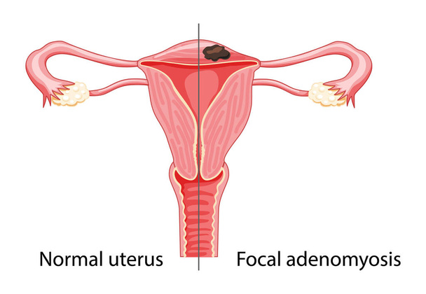 Adenomyosis Focal Human anatomy Female reproductive Sick system vs versus normal Compared educational healthy abnormal - Vector, Image