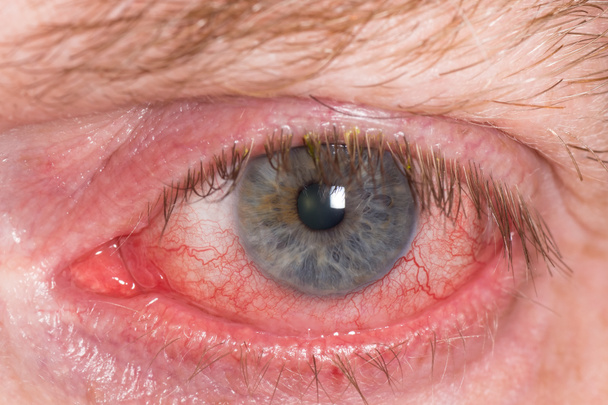 Occhio irritato rosso
 - Foto, immagini