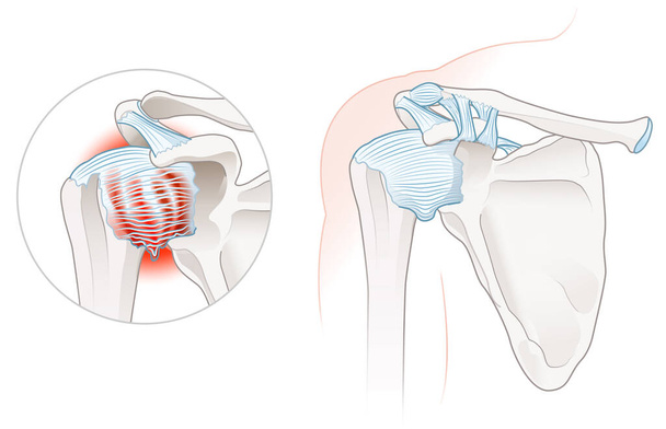 Illustration showing frozen shoulder adhesive capsulitis illustration. Labeled - Photo, Image