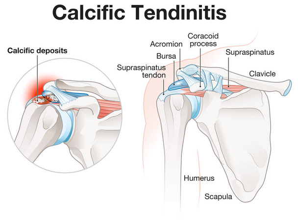 Illustration showing calcific cendinitis shoulder - Zdjęcie, obraz