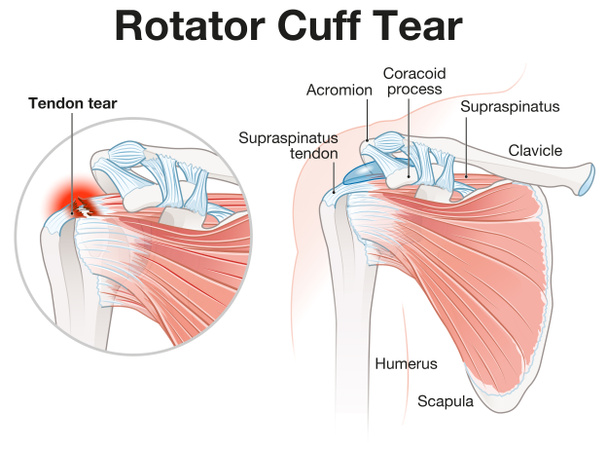Illustration showing rotator cuff tear shoulder illustration - Photo, Image