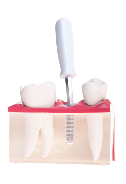 Implant fogorvosi modell - Fotó, kép