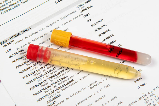 Testbuis met urineanalyse, over een papier met de testresultaten - Foto, afbeelding