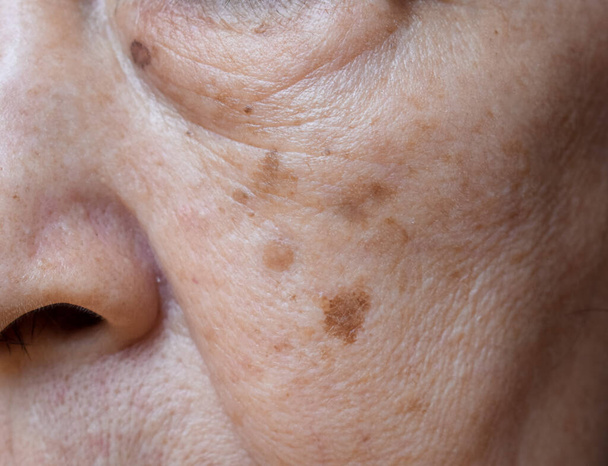 Small brown patches called age spots on face of Asian elder woman. They are also called liver spots, senile lentigo, or sun spots. Closeup view. - Photo, Image