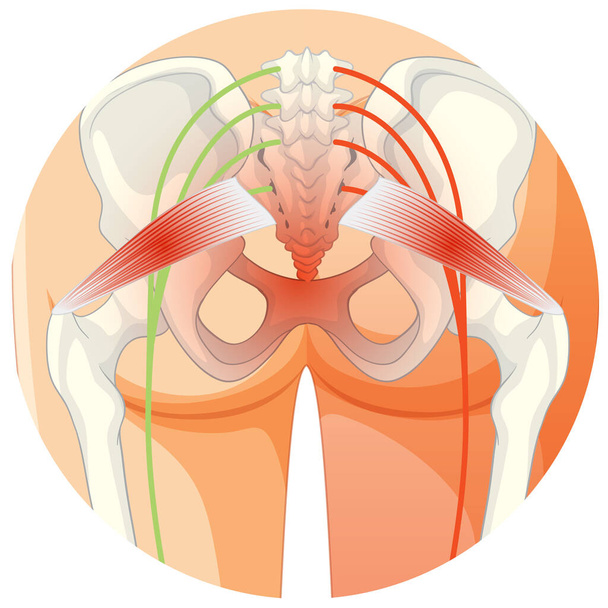 Parte bassa della schiena affetta da spondilite anchilosante illustrazione - Vettoriali, immagini