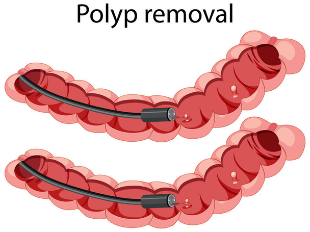 Diagram tonen poliep verwijdering illustratie - Vector, afbeelding