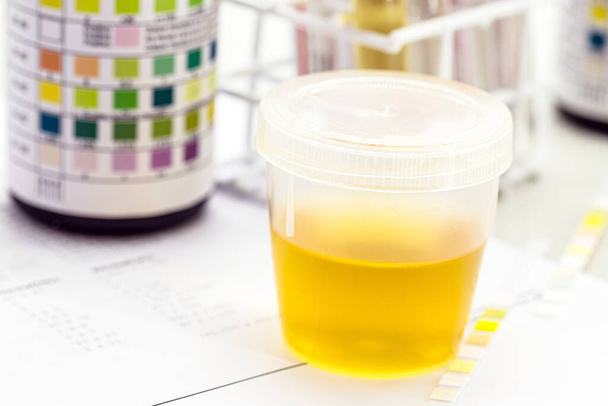 urine bottle, urinalysis to analyze Leukocytes, Urobilinogen, Bilirubin, Blood, Nitrite, pH, Density, Protein, Glucose and ketone bodies (ketosis) - Photo, Image