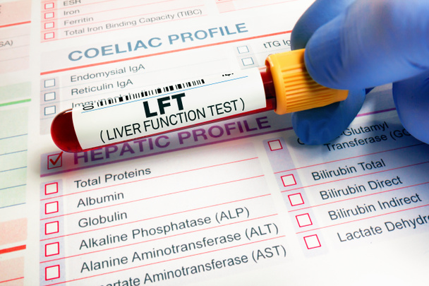 血液学研究室での肝分析のための患者の血液管検査.実験室でのLFT肝機能検査のためのサンプル要求フォーム上の血液サンプル - 写真・画像