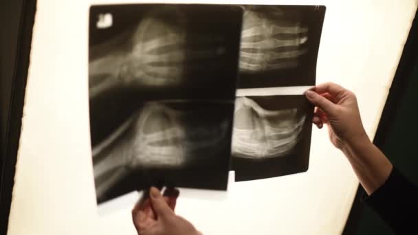 De hand van de verpleegster heeft een röntgenfoto van de arm. Armfractuur, geneeskunde. - Video