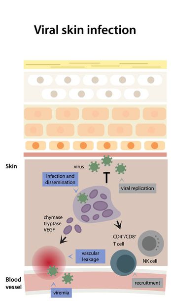 Virale Hautinfektion. Das Schema der Virusreplikation durchläuft Prozesse der Infektion und Verbreitung, der Gefäßleckage und Virämie. - Vektor, Bild