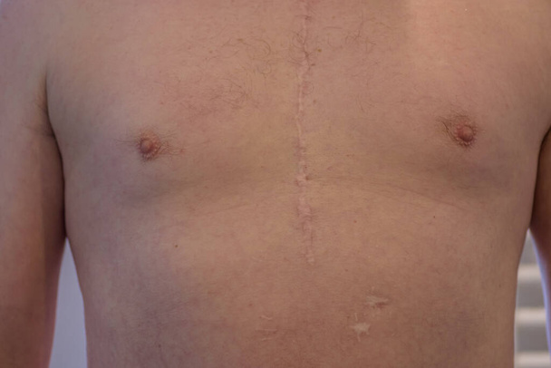 Cicatrice d'une opération à cœur ouvert sur un homme blanc, où le sternum a été coupé en deux, et la cage thoracique s'est ouverte. - Photo, image