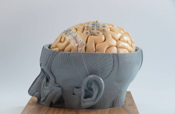 Deux électrodes de grille sous-durale pour l'enregistrement d'ondes cérébrales ou l'électroencéphalographie sur le cortex modèle artificiel du cerveau
 - Photo, image