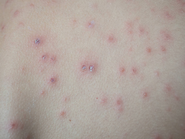 tratamiento de úlceras por varicela, varicela con crema médica en la piel del niño - Foto, imagen