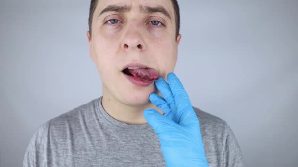 Lengua negra. Un hombre muestra las consecuencias de una lesión, mordedura o quemadura de la lengua. La parte está dañada. Tratamiento de lesiones internas - Metraje, vídeo