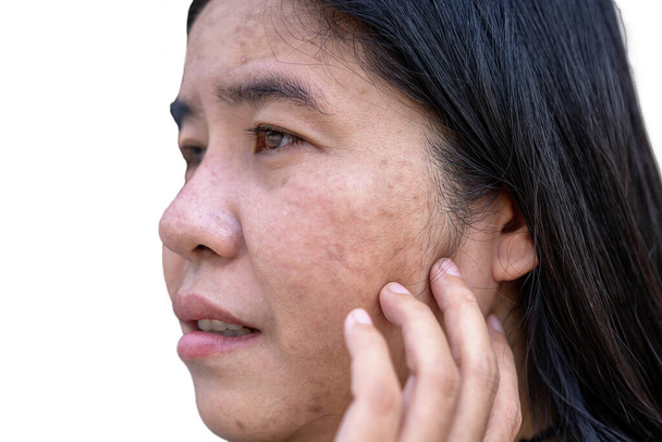 Пов'язаний з обличчям дорослої азіатки має веснянки, великі пори, чорні примхи і шрами проблеми не піклуватися протягом тривалого часу. М'який фокус на проблемах зі шкірою. Концепція лікування та догляду за шкірою - Фото, зображення