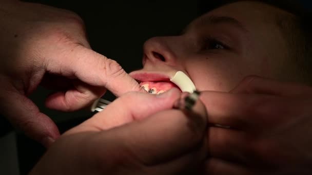 Τοποθέτηση στηριγμάτων στα στραβά δόντια του παιδιού, ενός λευκού συσπειρωτήρα στα χείλη για να διευκολυνθεί το έργο του ορθοδοντικού. - Πλάνα, βίντεο