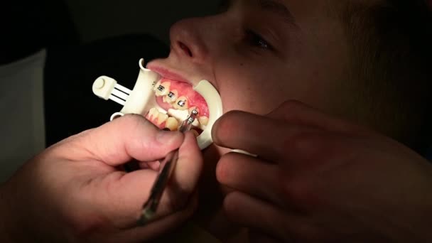 Installatie van beugels op de kromme tanden van het kind, een witte oprolmechanisme op de lippen om het werk van de orthodontist te vergemakkelijken. - Video