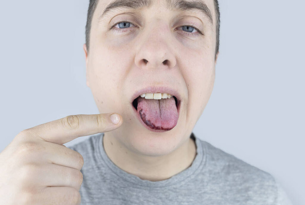 Černý jazyk. Muž vykazuje následky zranění, kousnutí nebo popálení jazyka. Část je poškozená. Léčba vnitřních zranění - Fotografie, Obrázek