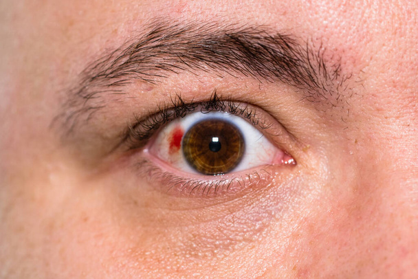 Oogletsel, jonge man met gebarsten bloedvat in het oog, vermoeidheid, problemen met de bloedvaten - Foto, afbeelding