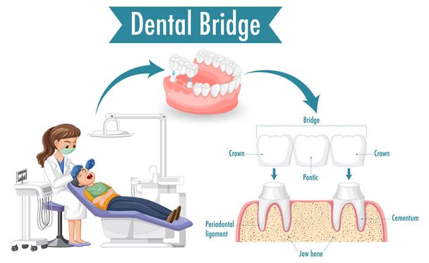 Infografía de humanos en puente dental sobre fondo blanco ilustración - Vector, Imagen
