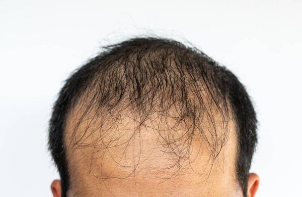 Primo piano della calvizie maschile asiatica. La perdita di capelli (alopecia) può colpire solo il cuoio capelluto o tutto il corpo. Può essere il risultato di ereditarietà, cambiamenti ormonali o una parte normale dell'invecchiamento. - Foto, immagini
