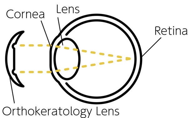 Ilustrace ortokeratologie a korekčních čoček vidění (po montáži) - Vektor, obrázek