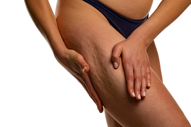 woman body care lifestyle concept of leg with wrinkled skin and cellulite on white background - Foto, afbeelding
