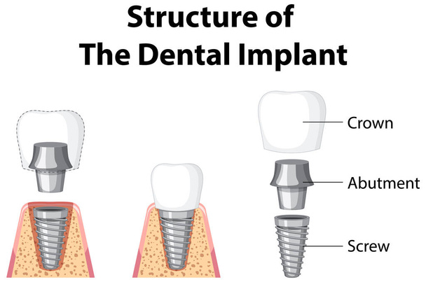 Инфографика человека в структуре зубного импланта - Вектор,изображение