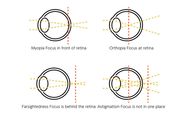Medical Illustrations of Vision and Refractive Error, Normal, Myopia, Hyperopia, Astigmatism - Vector, Image