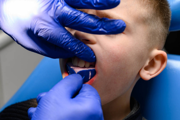 Impresión mandibular con un modelo de diagnóstico de silicona, dientes torcidos en un niño, una visita al ortodoncista. - Foto, imagen
